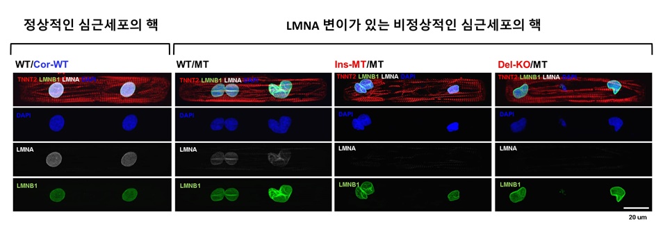 일반인으로부터 생성된 역분화줄기세포 유래 심근세포는 정상적인 핵막 구조를 가지고 있으며 유전자의 발현이 정교하게 조절되고 있다. 특히 유전자의 발현이 억제되어 있는 부분은 핵막의 lamin A/C (LMNA)에 주로 결합되어 있다(왼쪽, 빨간색 네모=발현이 억제되어 있는 유전자). 하지만 환자로부터 생성된 역분화줄기세포 유래 심근세포는 비정상적인 핵막의 형태를 띄고 있으며(아래 세포 사진) 일부 유전자들이 발현이 증가하고 (오른쪽, 파란색 동그라미=비정상적인 발현이 시작되는 유전자) 이에 따라서 기존에 억제되어 있던 신호전달 체계가 활성화되어 질환이 유발됨을 확인하였다.