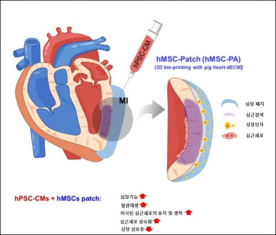 ​심장패치(중간엽줄기세포)와 심근세포(유도만능줄기세포) 이식을 이용한 심근경색 치료