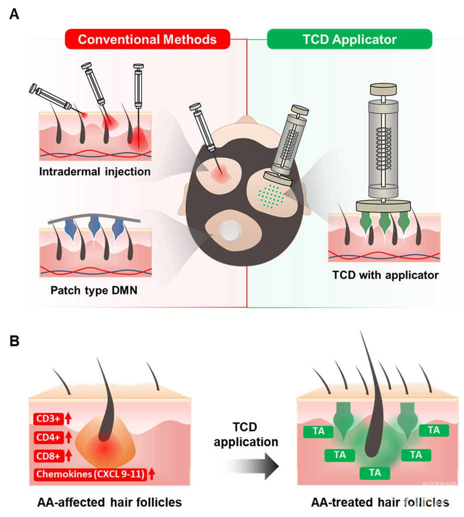 TA-encapsulated Candlelit-dissolving Microneedle(TCD)의 투여 원리. TCD는 기존 용해성 마이크로니들 패치와는 달리 단시간에 적용되는 이식제 형태를 가진다.
