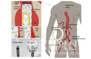 스텐트 근위부에 부착된 초박막 유연 센서가 혈액 유입을 감지한다. 센서 내부 LC 공진 회로에서 발생한 주파수 변화는 외부 리더기로 무선 전송된다. 이를 통해 환자는 집에서도 실시간으로 스텐트 상태를 확인할 수 있다.
